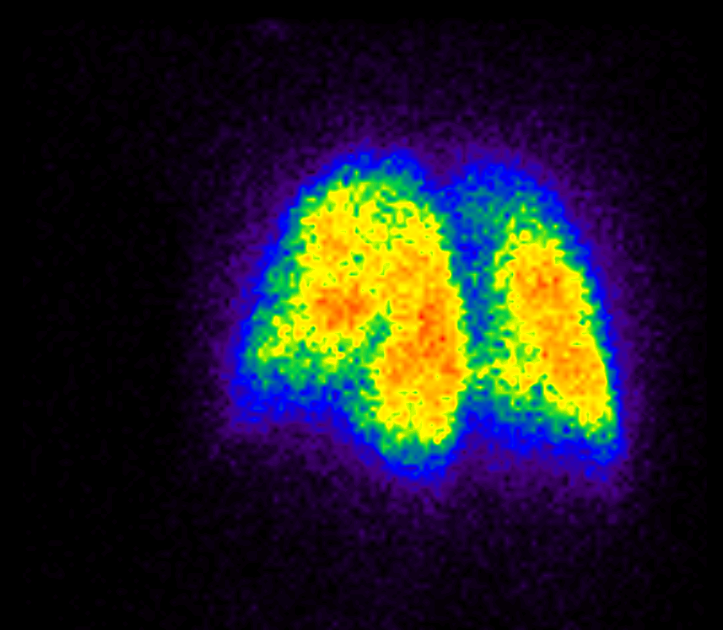 Gammagrafía Pulmonar de ventilación