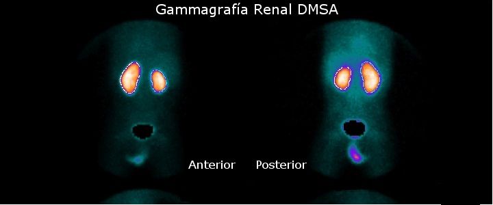 Gammagrafía Renal DMSA