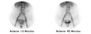 Estudio isotópico de hemorragia gastrointestinal