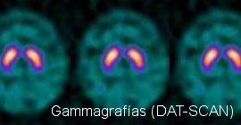 Gammagrafías (DAT-SCAN) Gammagrafías (DAT-SCAN)