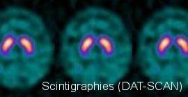 Scintigraphies (DAT-SCAN) Scintigraphies (DAT-SCAN)