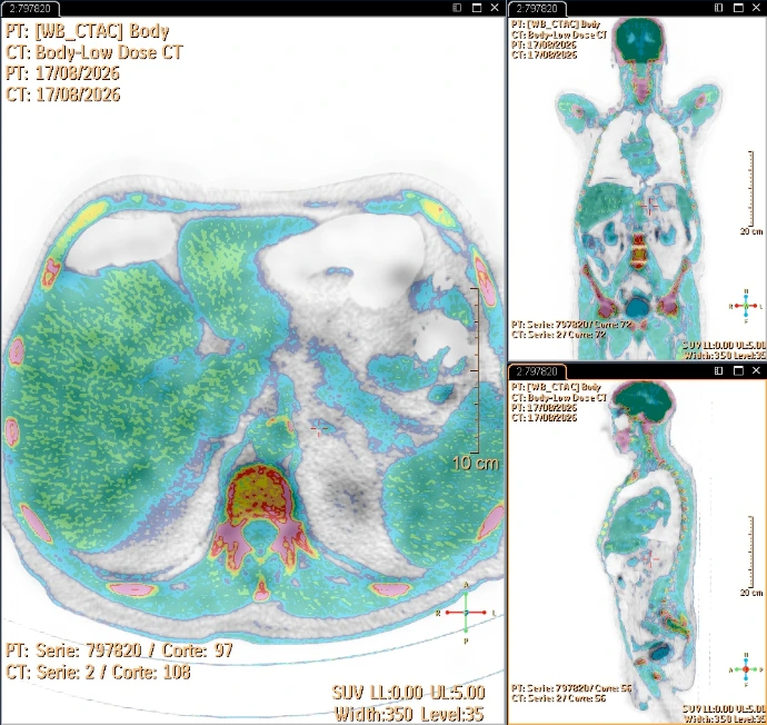Cortes axial coronal y trasversal de PET FDG
