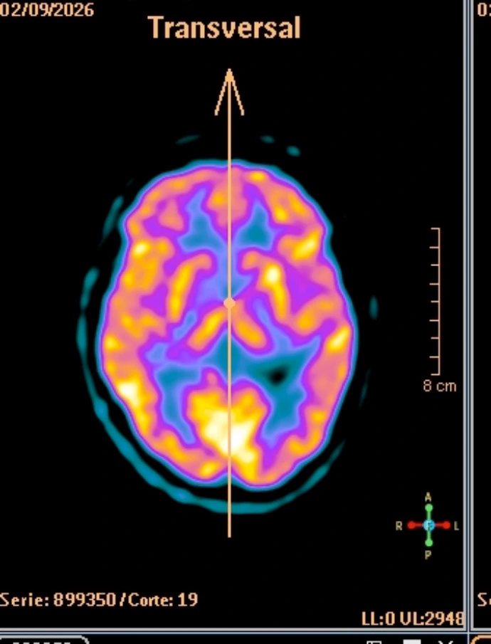 Cerebro visto con Fluor Dopa